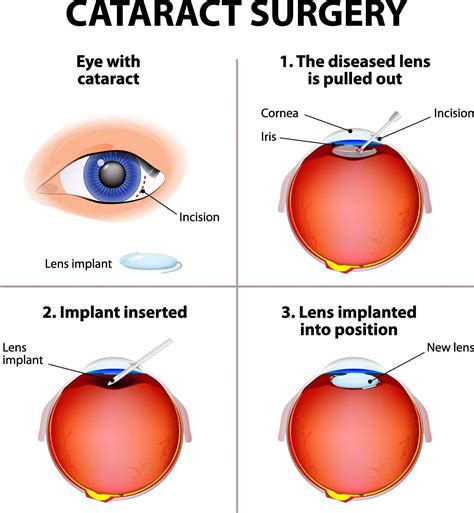 cataract eye surgeons near me.